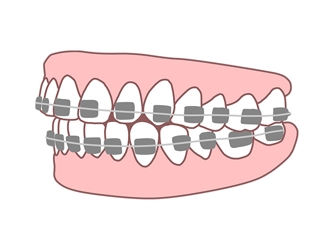 ワイヤー矯正（表側：セルフライゲーション）