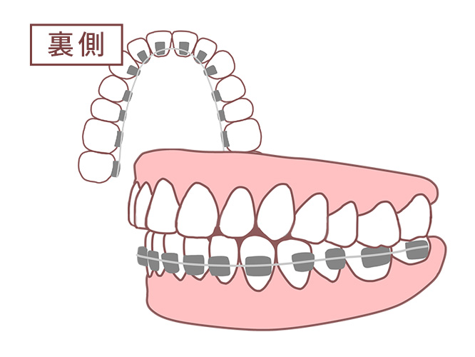 ハーフリンガル矯正