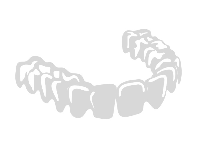 マウスピース矯正