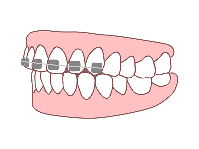 部分矯正（ワイヤー）